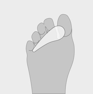 Hammer toe crests